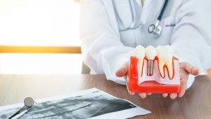 consejos dentistas Mallorca implantes